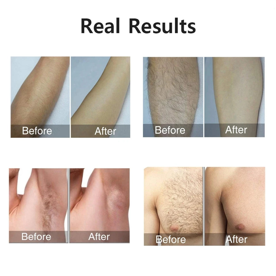 IPL Laser Hair Remover – 999,990 Flashes, 5 Levels, LCD Display for Women & Men
