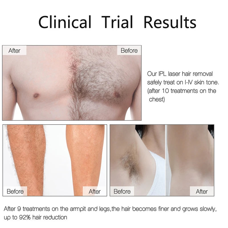 IPL Laser Hair Remover – 999,990 Flashes, 5 Levels, LCD Display for Women & Men
